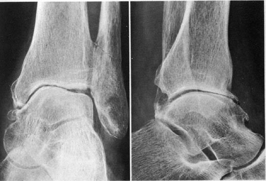 Artrose de enkel (bovenste spronggewricht) Orthopaedie